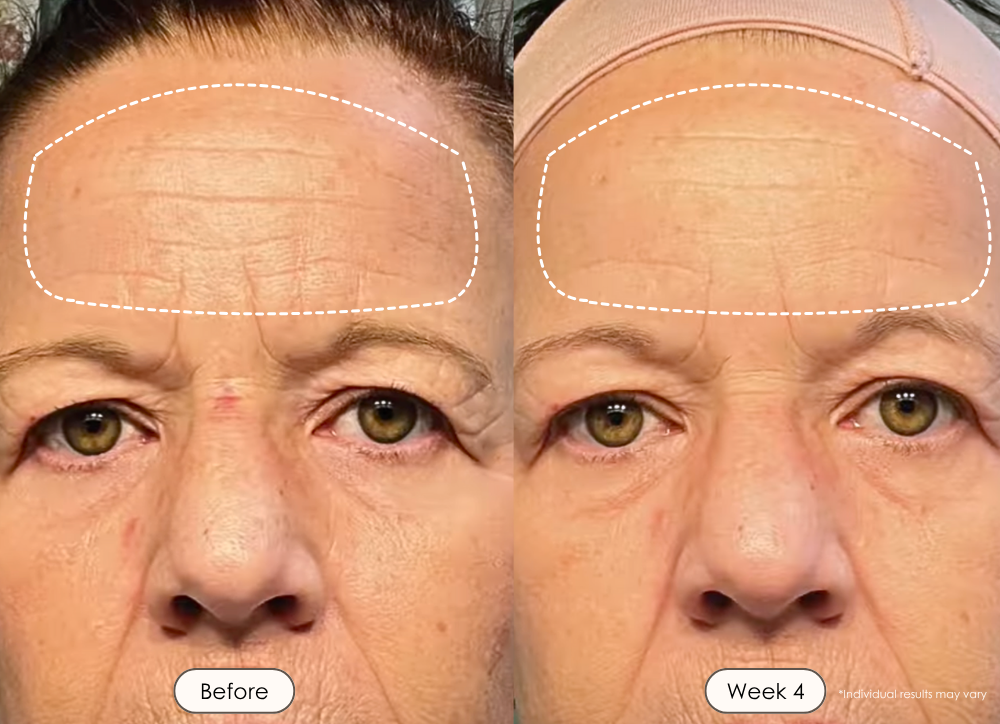 visible results after 30 days of using the LED light therapy wand