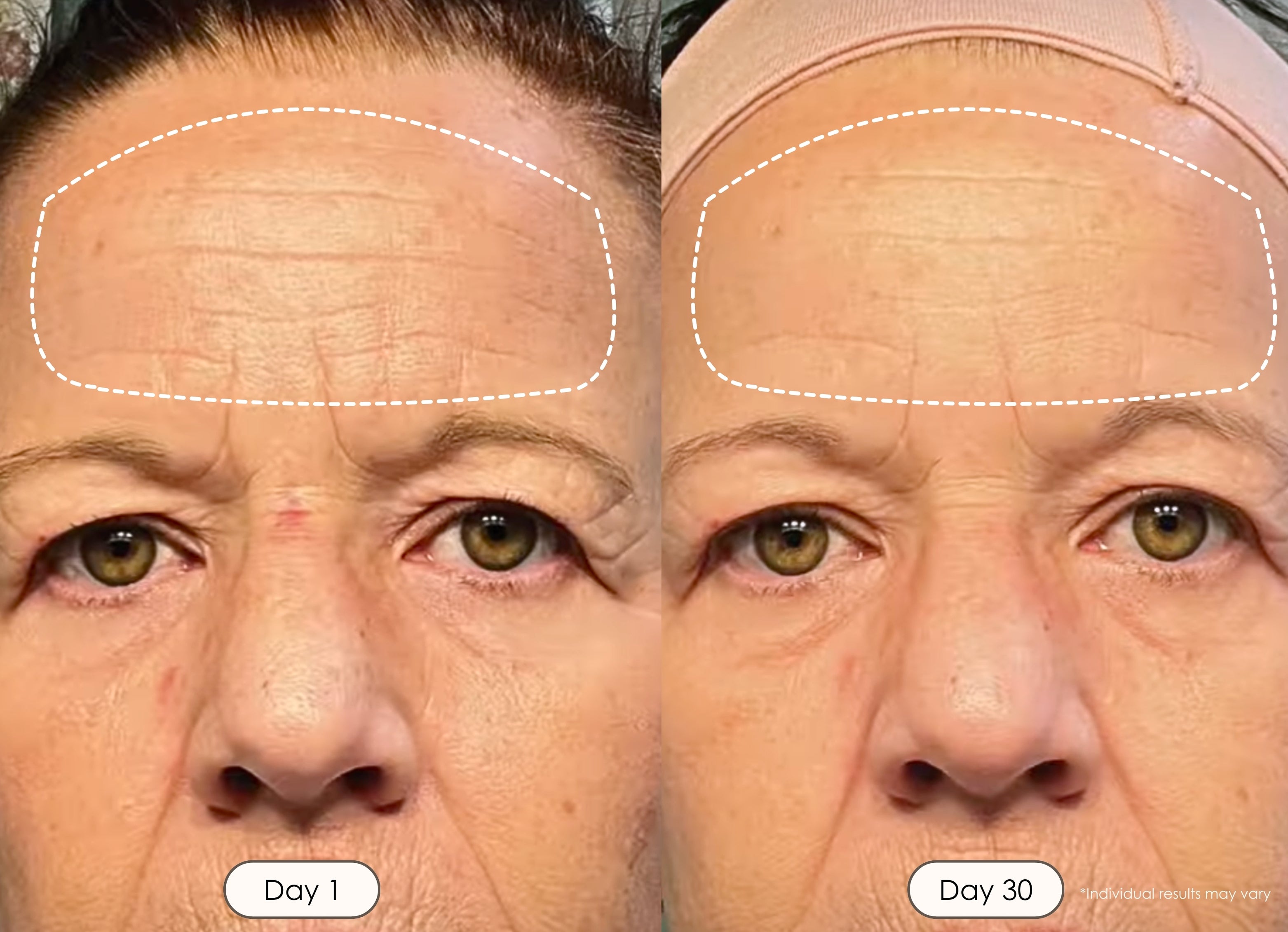 visible results after 30 days of using the LED light therapy wand